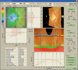 Kowa-Ophthalmic-Diagnostics-Nonmyd-WX-3D-Screenshot-05